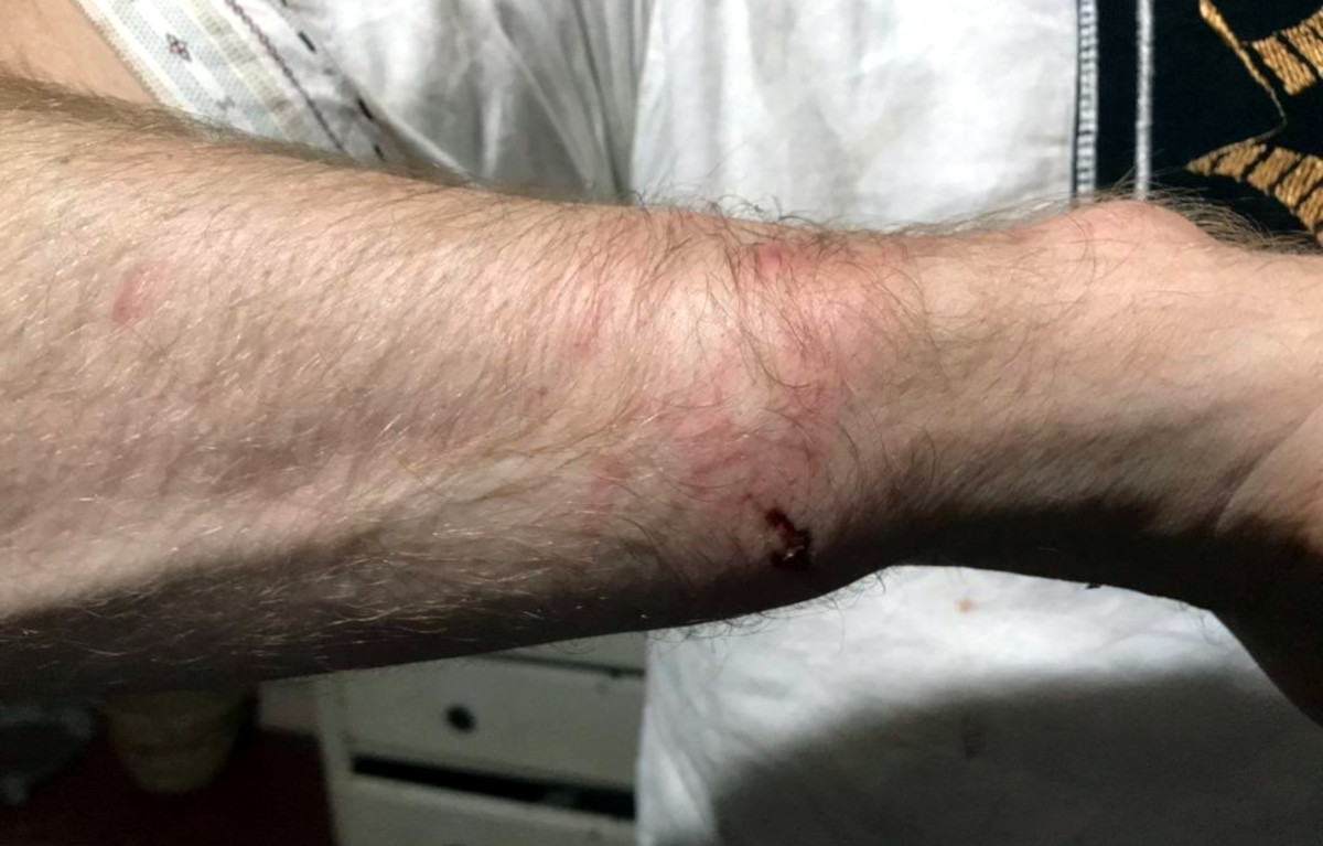 PICTURES: Doug Coltart Wounds From Assault By Zimbabwe Police