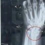 Govt Repairs X-ray Machine Which Broke Down Four Years Ago