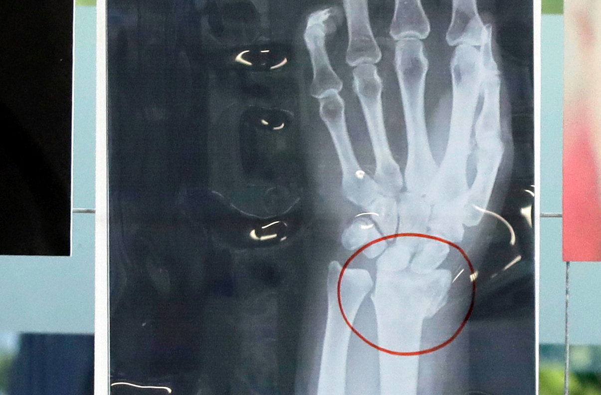 PICTURES: X-rays Of Women Attacked By Men Displayed At Milan Hospital