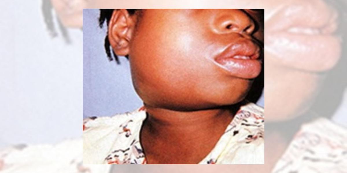 What You May Need To Know About Mumps/Mahumunya/Amatitiyane