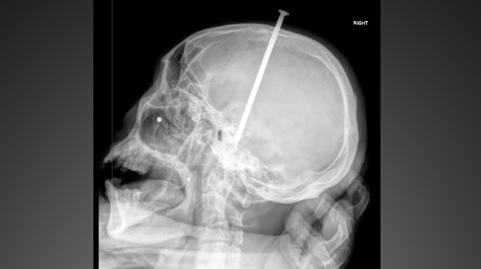 Gweru Hospital Specialists Successfully Remove Steel Nail From 75-Year-Old Man’s Skull